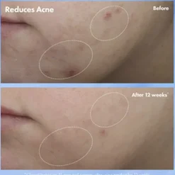 Clear Improvement Acne & Blackhead Clearing Hydrating Moisturizer Loti